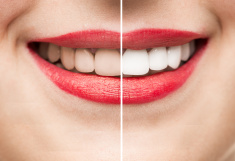 stock-photo-85121673-teeth-after-and-before-whitening.jpg