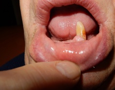 stock-photo-85927231-last-natural-tooth-still-sanding.jpg