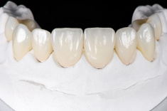 stock-photo-95144157-prepless-veneers.jpg